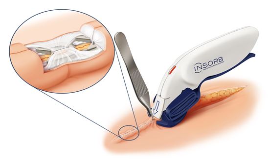 Insorb® subkutikulärer Hauthefter_0